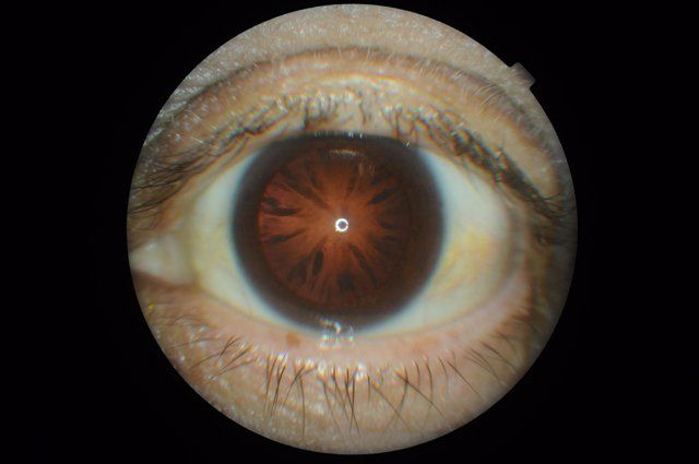 Diabetic Cataract