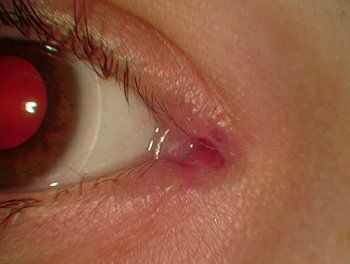Lacrimal Tube