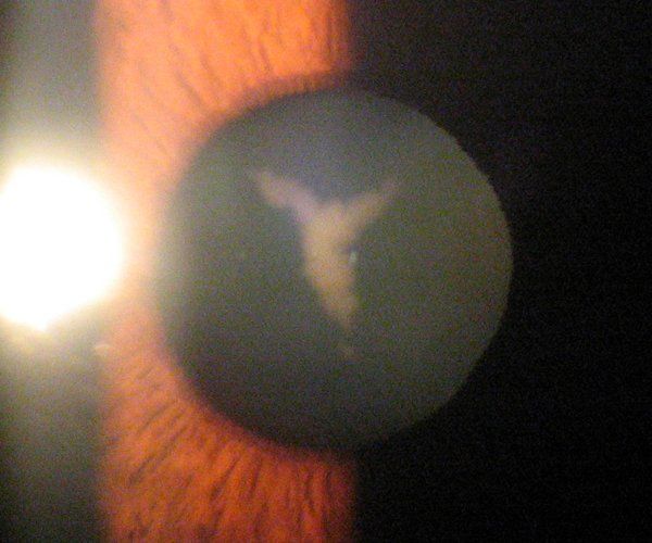 Congenital Cataract
