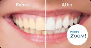 A before and after photo of a woman's teeth.