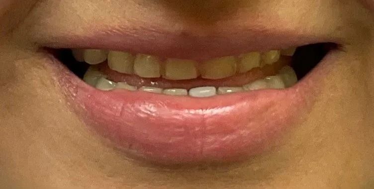 Close-up of a person's slightly open mouth showing yellowed teeth and full, pink lips.