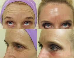 Woman's forehead before and after treatment, showing reduction in wrinkles with an apparent cosmetic procedure.