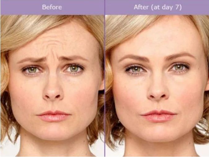 Woman's forehead before and after treatment, showing reduction in wrinkles with an apparent cosmetic procedure.