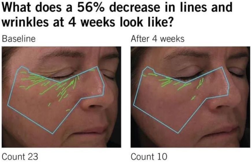Comparison of a woman's face, showing fewer wrinkles after 4 weeks of treatment.