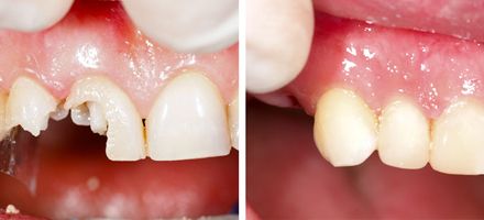 tooth-repair
