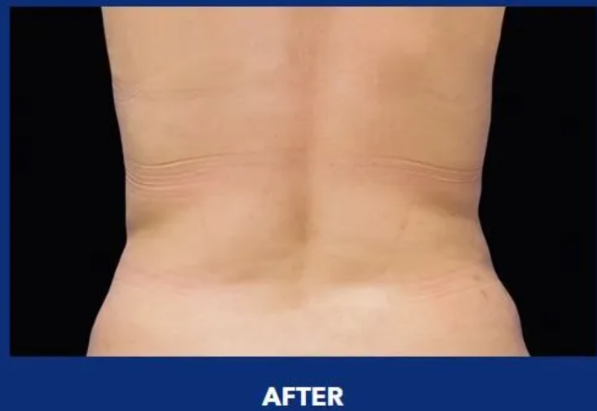 COOLSCULPTING
