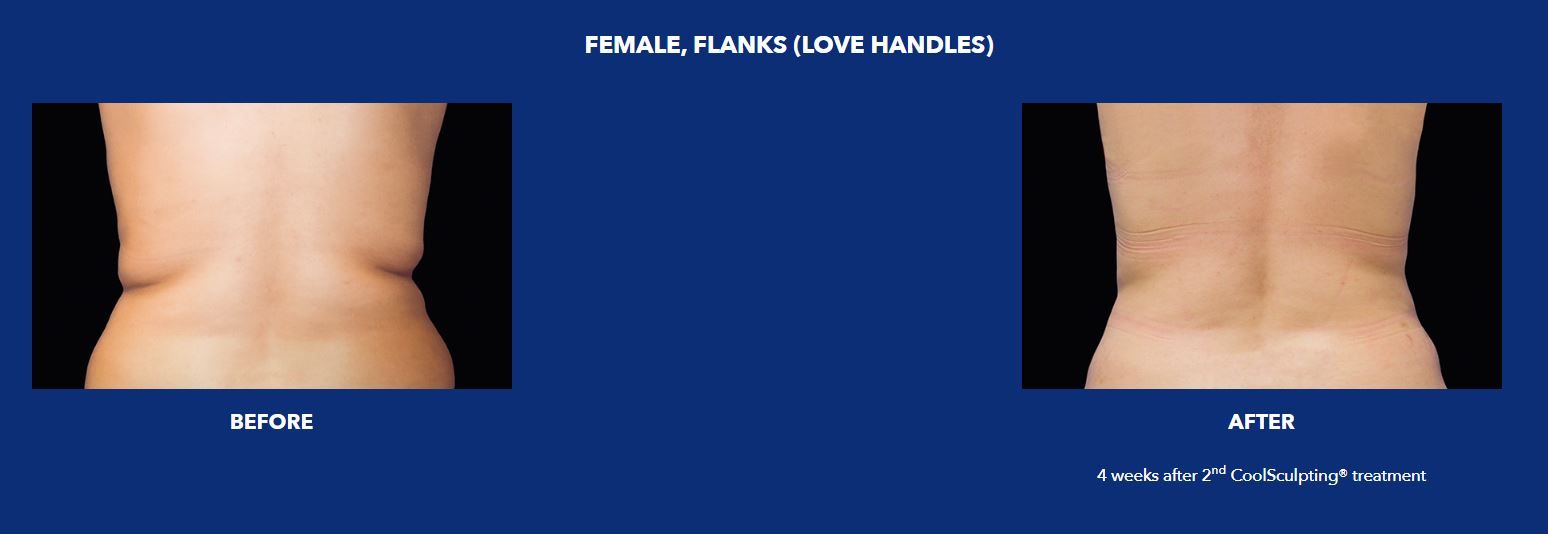 CoolSculpting flanks