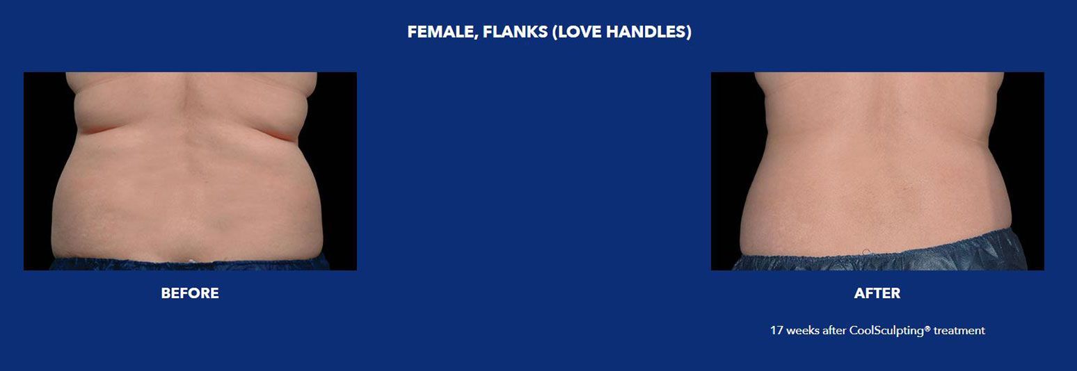 CoolSculpting female flanks