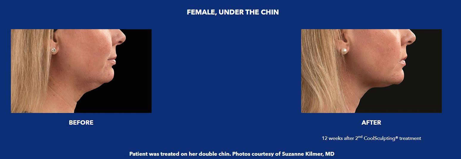 CoolSculpting female chin