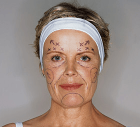 Facelifts