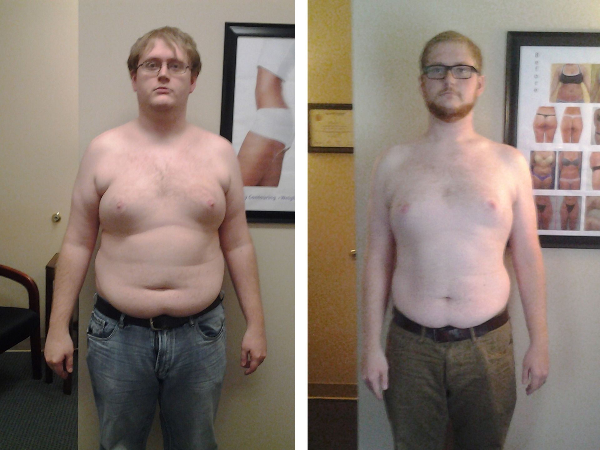 Two photos side by side of a person. Left: before, overweight. Right: after, less weight, with beard.