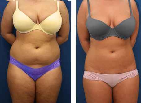 Before-and-after of a person's torso. Left: wearing yellow bra and purple underwear. Right: wearing gray bra and pink underwear.