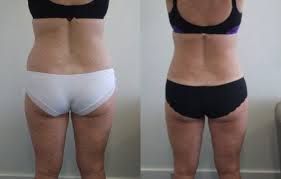 Side-by-side comparison of a person's back, showing a change in shape. The person wears underwear and a sports bra.