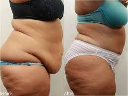 Side-by-side comparison: Before and after abdominal fat reduction, showing skin folds.