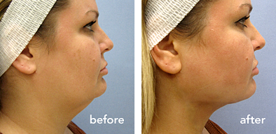 Side-by-side comparison shows a woman's face before and after a cosmetic procedure to reduce neck fat.