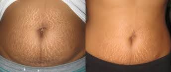Abdomen with stretch marks on the left, improvement on the right. Skin is tan.