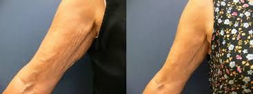 Arm skin before and after treatment, demonstrating reduced wrinkles.