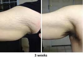 Comparison of underarm skin: before and after three weeks of treatment, with reduced discoloration.