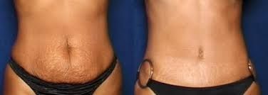 Before and after image of a person's abdomen, showing skin with stretch marks, then smoother skin.