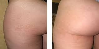 Comparison of a leg with stretch marks to one without stretch marks.