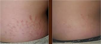 Side-by-side comparison of skin with stretch marks before and after treatment.