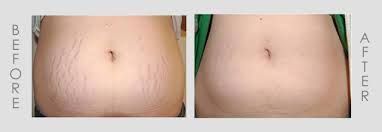 Comparison of a stomach with stretch marks (before) and a smoother appearance (after).