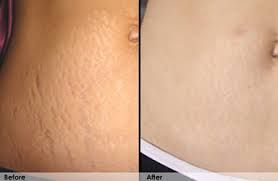 Before and after comparison of stretch marks on an abdomen, showing improvement after treatment.