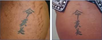 Tattoo on skin before and after a procedure. The tattoo features vertical Chinese characters with an arrow.