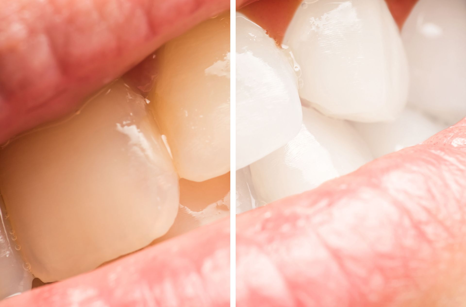 Close-up of teeth and lips, showing before-and-after whitening with a vertical split comparison.