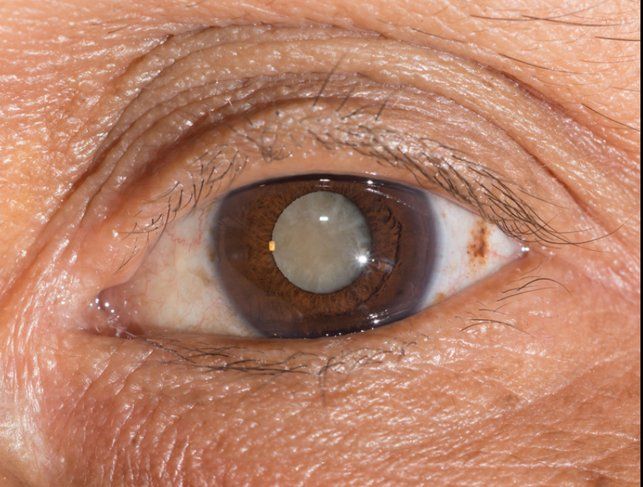 Cataract