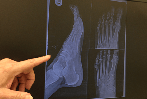 An x-ray of a patient's foot