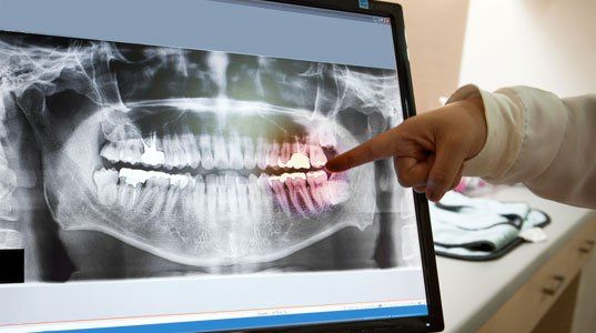 Panoramic dental X-Ray with hands point in Computer screen and film