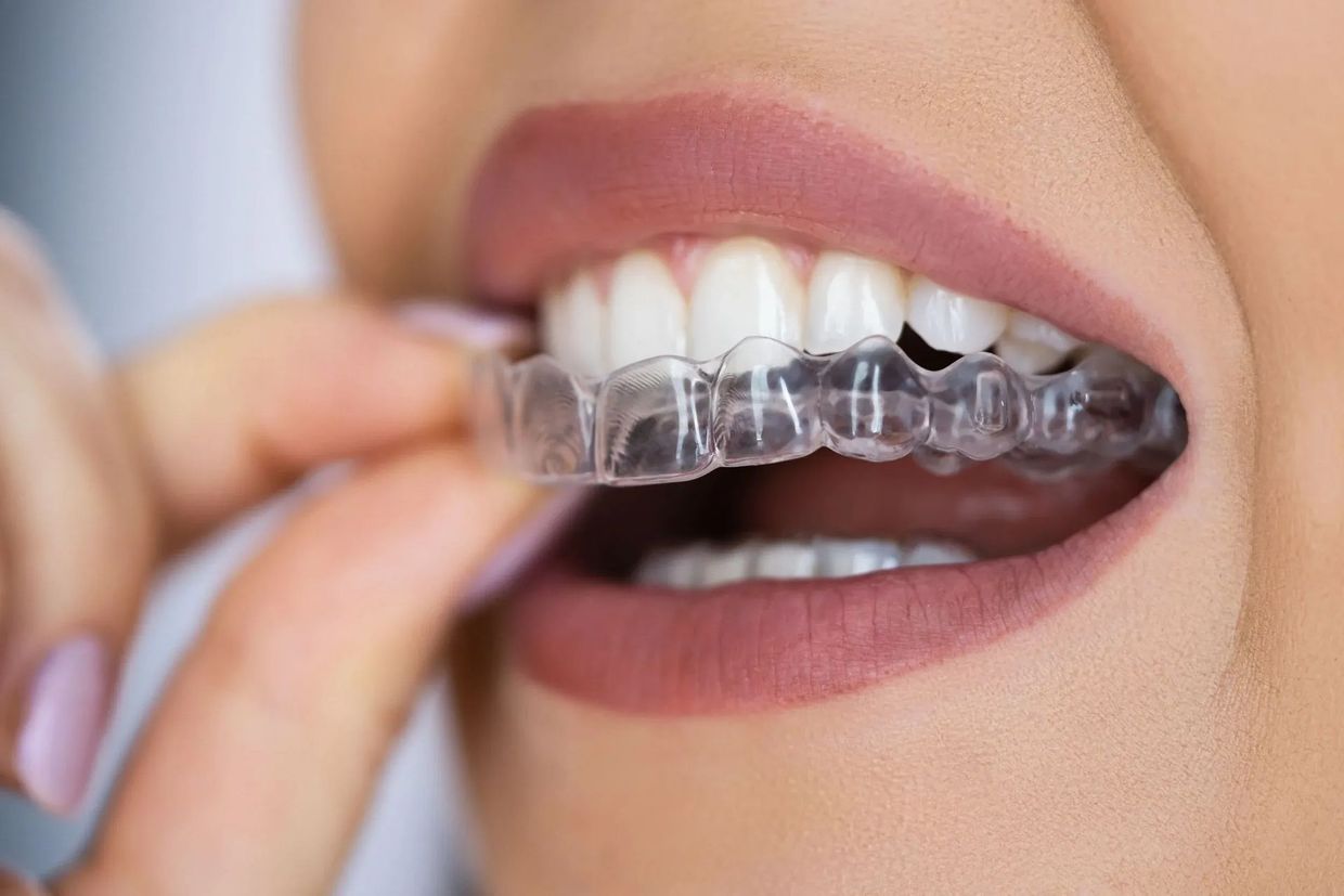 Woman placing a clear aligner over upper teeth.