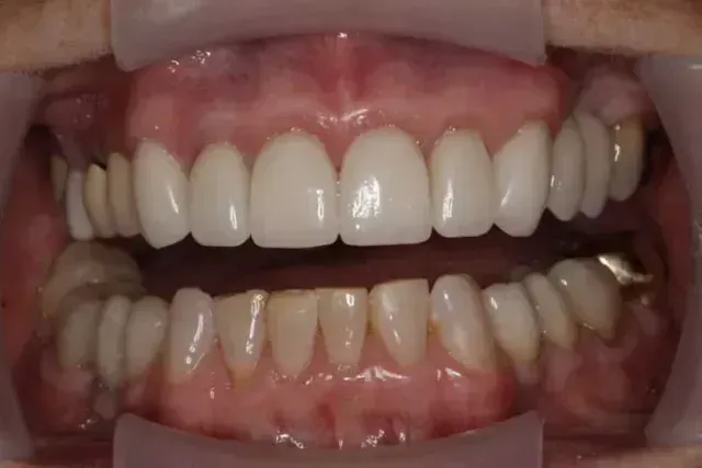 Mouth with upper teeth showing veneers, lower teeth are not veneered. The mouth is held open by a retractor.