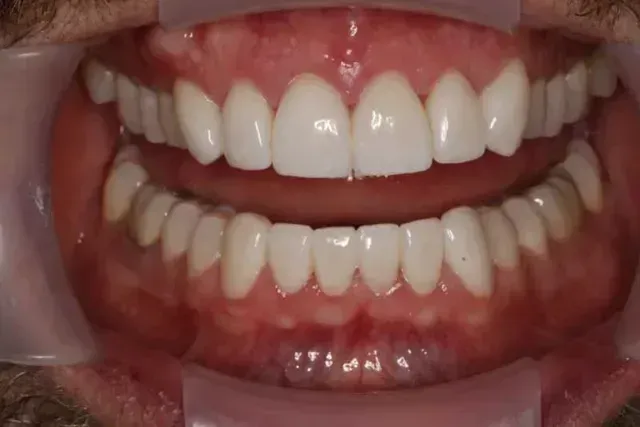 A close-up view of a person's open mouth, showing healthy, white teeth and pink gums.