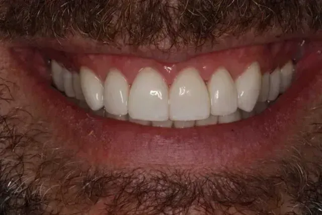 Close-up of a smiling mouth with bright white teeth. Pink gums and visible beard.