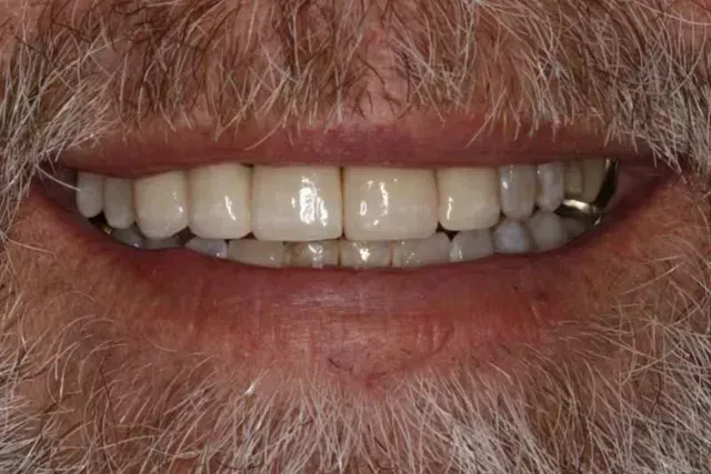Close-up of a person's smiling mouth showing clean, white teeth and a well-groomed beard.