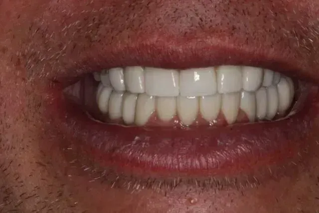 Close-up of a person smiling, revealing a full set of bright, white teeth.