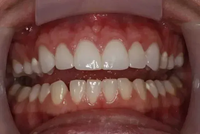Open view of teeth, upper teeth appear whiter than lower teeth, gums are red.