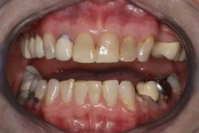 Open mouth dental view; chipped and discolored teeth, some with fillings and crowns, visible gums.