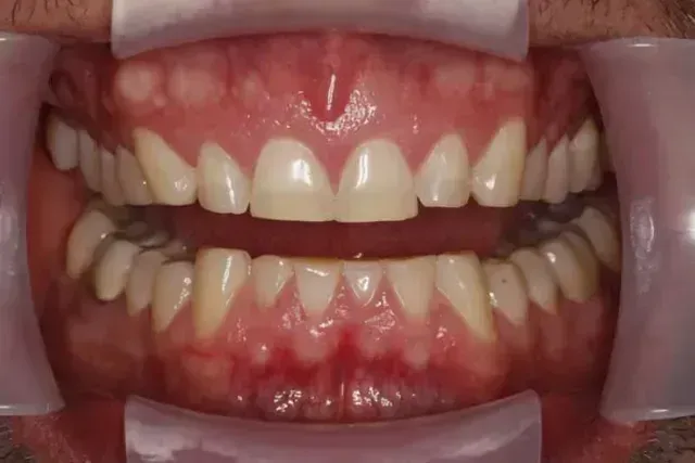 Mouth open, showing upper and lower teeth. Gums are pink, teeth are white/yellow. Retractors hold mouth open.