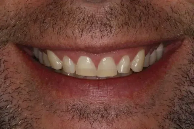 Close-up of a smiling mouth with visible teeth. The person has a short beard and mustache.
