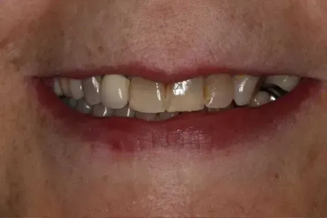Close-up of a person's smile, showing teeth with a missing tooth and other discoloration. Red lipstick.