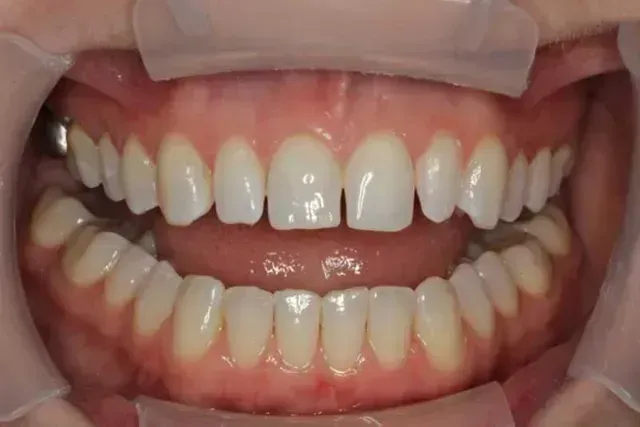 Close-up of a person's teeth, showing a gap between the front teeth. Dental mouth retractor is in place.