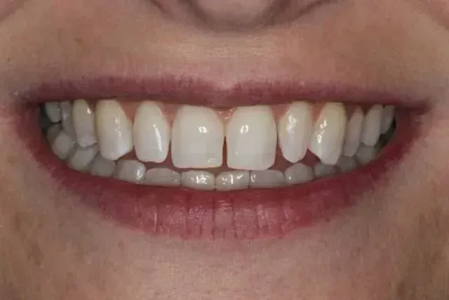 Close-up of a person's smiling mouth showing teeth with a gap between the two front teeth and red lipstick.