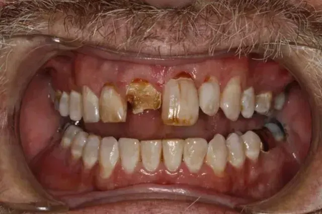 Mouth with decayed and damaged teeth; upper central incisor missing, others discolored, yellow-brown.