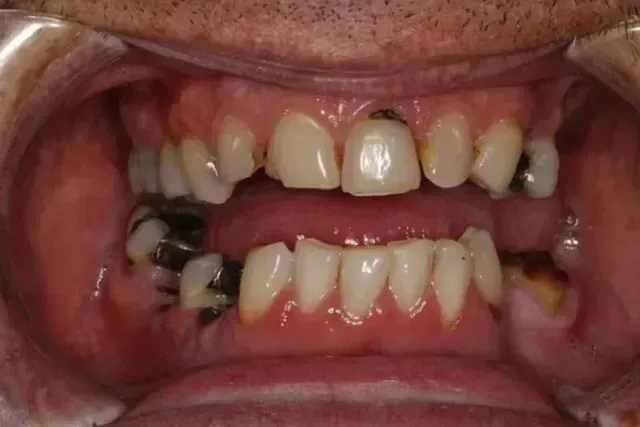 Open mouth showing severely decayed teeth and visible dental work.