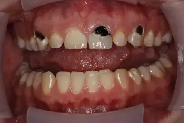 Mouth with teeth, some with dark cavities. Tongue and gums visible. Dental examination setup.