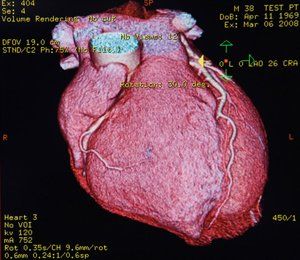 Heart shown on a monitor
