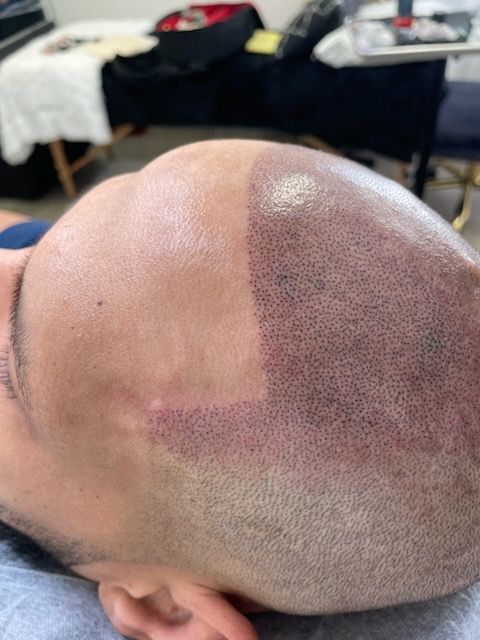 A close up of a man 's bald head with a scar on it.